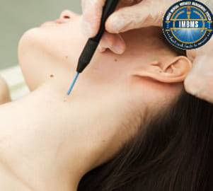Electrocautery skin tags moles removal treatment