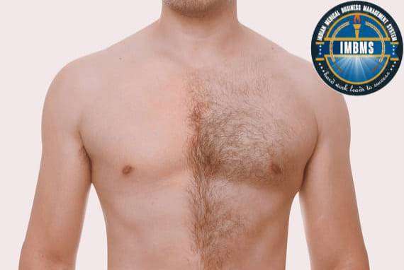 Guide For Chest Laser Hair Removal Dr Mahima Wadhwa